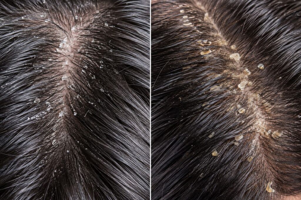 Comparison of dry scalp flakes versus dandruff flakes